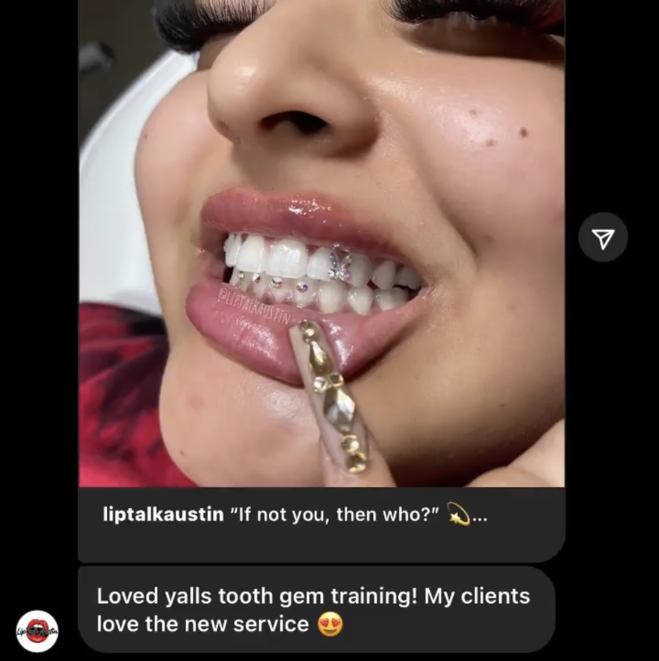 Tooth Gem Training by Dentalelle